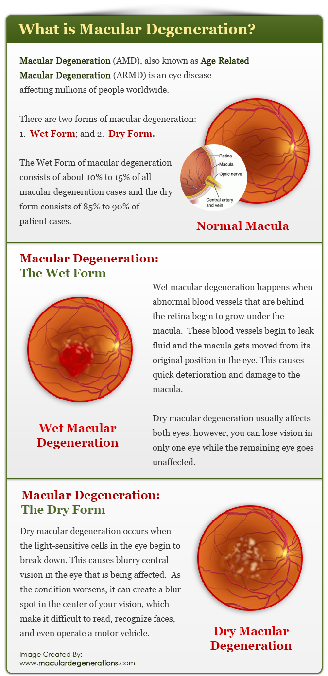 Macular Degeneration (AMD), also known as Age Related Macular Degeneration (ARMD) is an eye disease affecting millions of people worldwide.  There are two forms of macular degeneration: 1.  Wet Form; and 2.  Dry Form.  The Wet Form of macular degeneration consists of about 10% to 15% of all macular degeneration cases and the dry form consists of 85% to 90% of patient cases.  Macular Degeneration:  The Wet Form:  Wet macular degeneration happens when abnormal blood vessels that are behind the retina begin to grow under the macula.  These blood vessels begin to leak fluid and the macula gets moved from its original position in the eye.  This causes quick deterioration and damage to the macula.  Dry macular degeneration usually affects both eyes, however, you can lose vision in only one eye while the remaining eye goes unaffected.  Macular Degeneration:  The Dry Form  Dry macular degeneration occurs when the light-sensitive cells in the eye begin to break down.  This causes blurry central vision in the eye that is being affected.  As the condition worsens, it can create a blur spot in the center of your vision, which make it difficult to read, recognize faces, and even operate a motor vehicle.